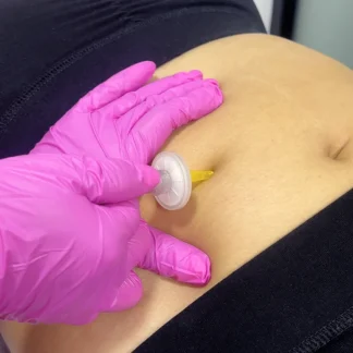 Carboxiterapia