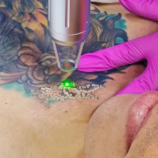 Eliminación de Tatuajes